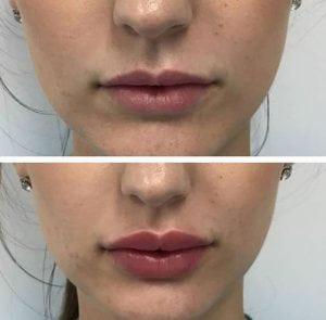 Van de de Lippenvergroting van de schoonheidsveiligheid van het de Vuller Vloeibare Gel Kosmetische de Lippeninjecties